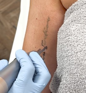 Tatoeage verwijderen