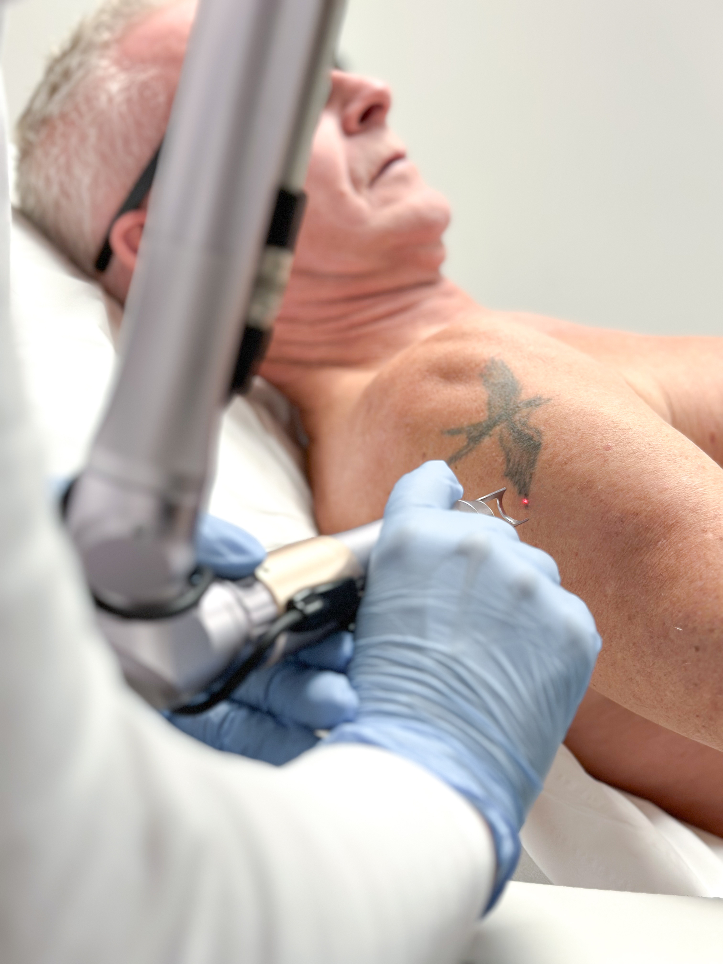Tattoo verwijderen bij laserkliniek Clinic-C in Zevenbergen