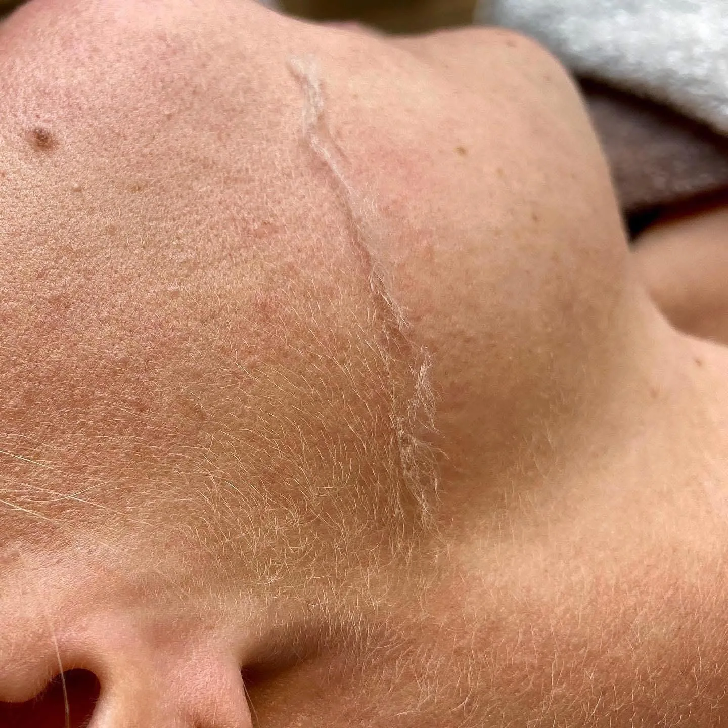 Dermaplaning